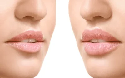 Ácido Hialurónico en Labios en Marbella: Reflejando la Belleza y la Innovación