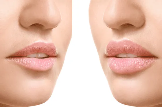 Ácido Hialurónico en Labios en Marbella: Reflejando la Belleza y la Innovación